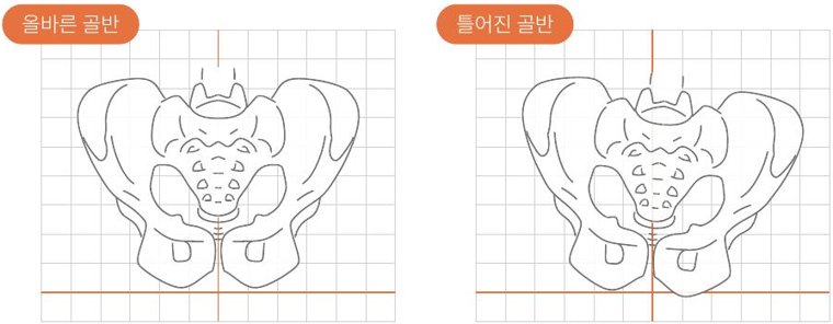 올바른 골반과 틀어진 골반 비교 그림